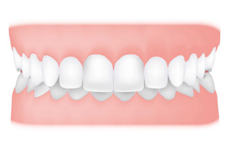 Исправление глубокого прикуса