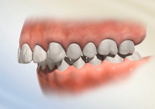 Исправление дистального прикуса