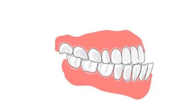 Исправление мезиального прикуса