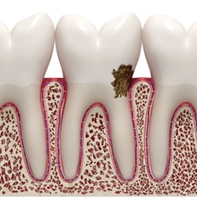 Лечение кариеса корня зуба