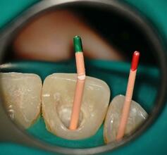 Лечение зубных каналов в Балашихе