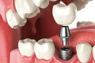 Зубной имплант Осстем с циркониевой коронкой под ключ