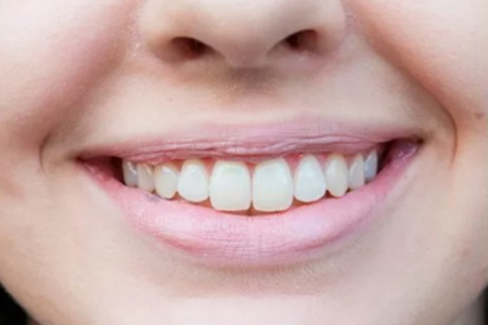 Исправление прикуса