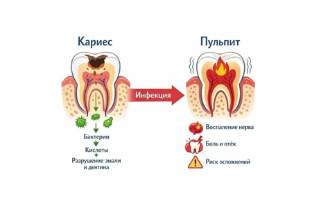 Пульпит постоянного зуба у ребенка
