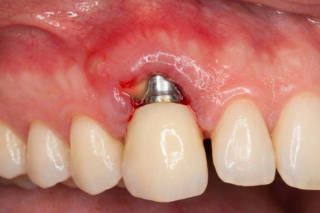 Отторжение импланта