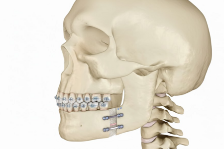 Ортогнатическая операция