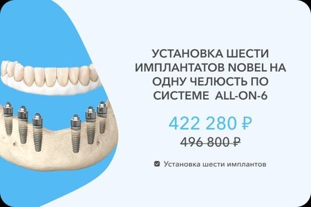 6 имплантов Нобель