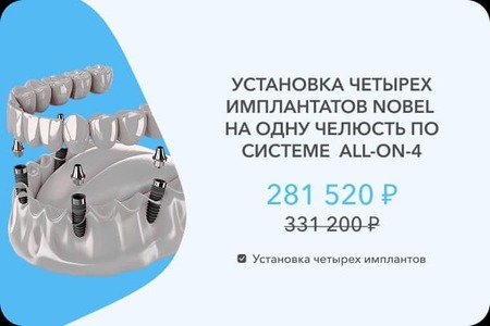 4 импланта Нобель