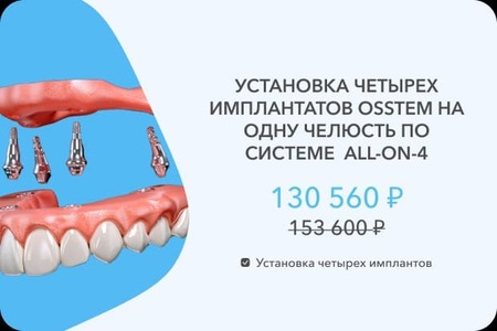 4 импланта Осстем