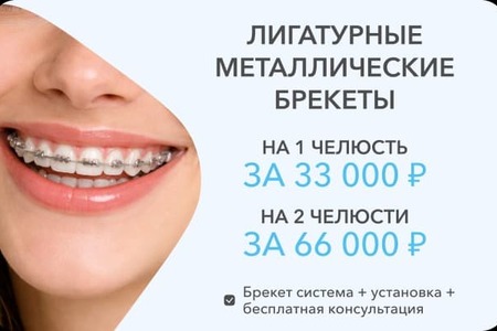 Лигатурные металлические брекеты