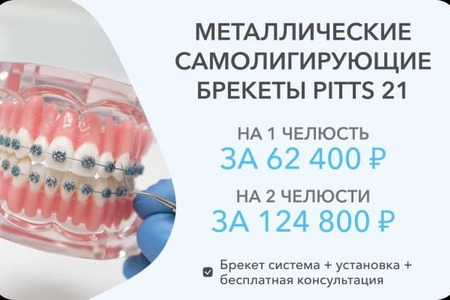 Брекеты Питтс