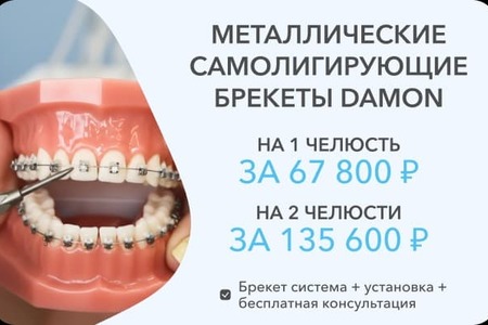 Брекеты Даймон