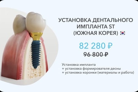 имплант ст